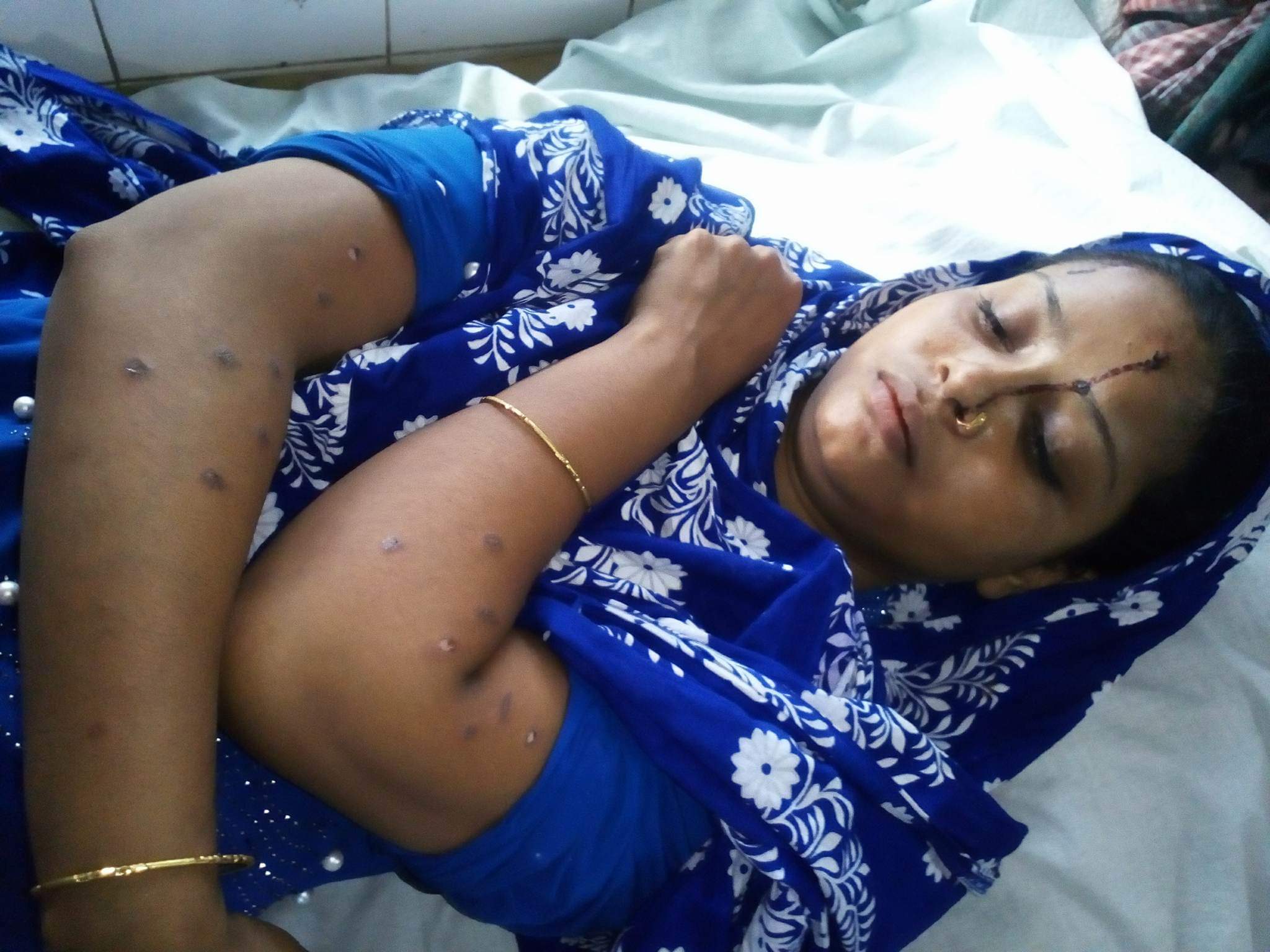 ভোলার পশ্চিম ইলিশায় গৃহবধুকে সিগারেটের আগুন দিয়ে  গাঁ ঝলছে দিয়েছে পাষান্ড ম্বামি কামাল