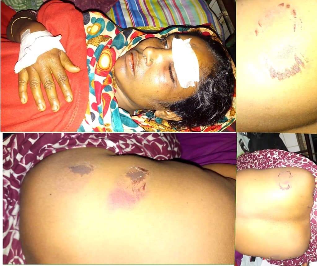 ভোলার উত্তর দিঘলদীতে স্বামীর আঘাতে স্ত্রীর সমস্ত শরীর ক্ষত বিক্ষত
