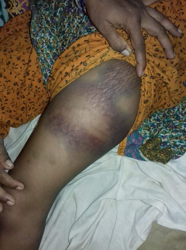 ভোলার রাজাপুরে পাষন্ড স্বামী মামুন এর নির্যাতনে অতিষ্ঠ দুই সন্তানের জননী লিমা।।