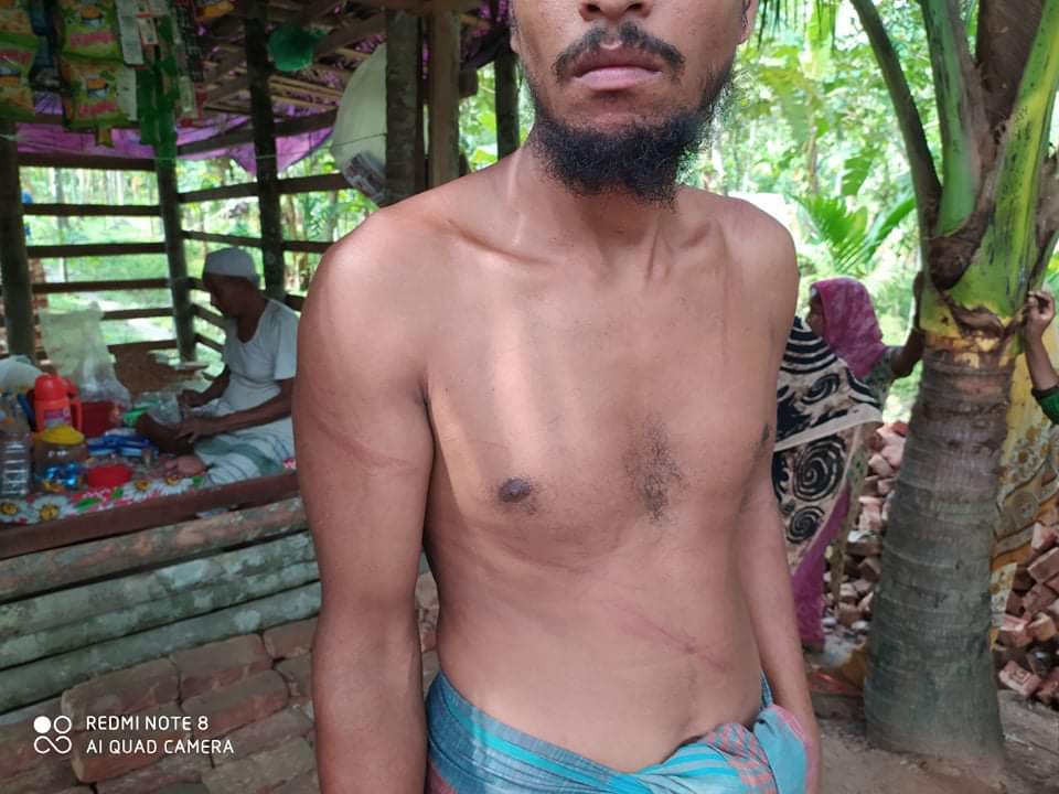 ভোলা উত্তর দিঘলদীতে প্রতিবন্ধিকে মেরে জমি দখলের চেস্টা ভুমিদস্যু সেলিম মোল্লাহ গংদের বিরুদ্ধে।।