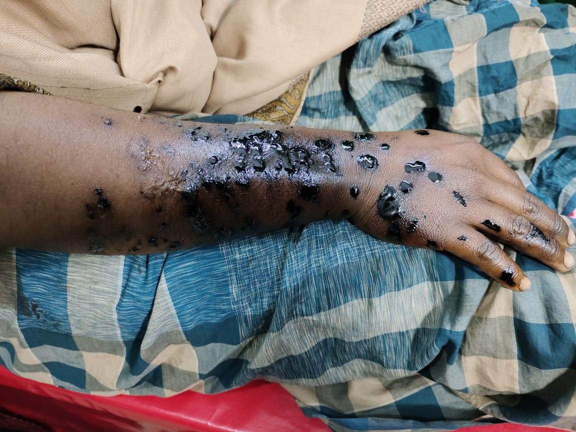 ভোলায় গরম বিটুমিন নিক্ষেপে ঝলসে গেলো অটো চালকের হাত-পা।।